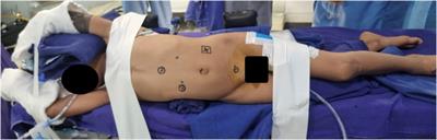 Analysis of outcomes of robot-assisted laparoscopic pyeloplasty in children from a tertiary pediatric center in South India